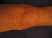 Photo: Gerald's knee